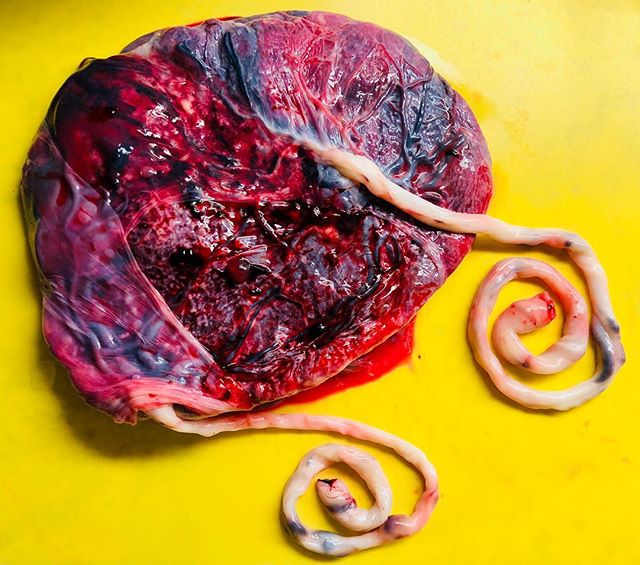 Twin love!! This Mono-di (monochorionic diamniotic) placenta is huge! Also called MoDi, this means these identical twin boys shared one placenta but had two separate amniotic sacs. Our body&rsquo;s are spectacular! ❤️❤️ #ocplacentaencapsulation #twin