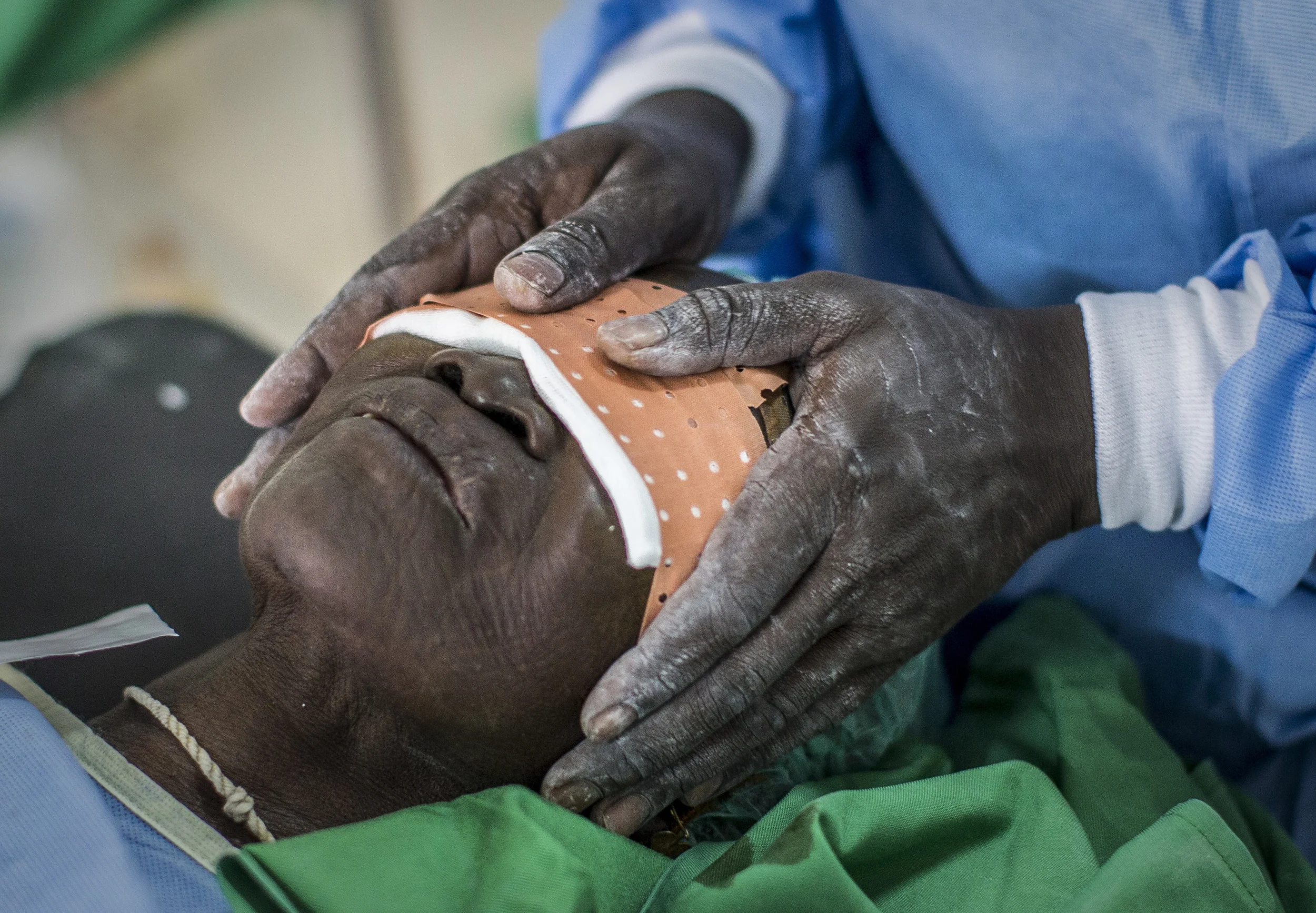  A patient is bandaged after a trichiasis operation at Kaffrin eye clinic, Senegal. Operations made possible by the funding of 'Sightsavers'. &nbsp;November 2013. 