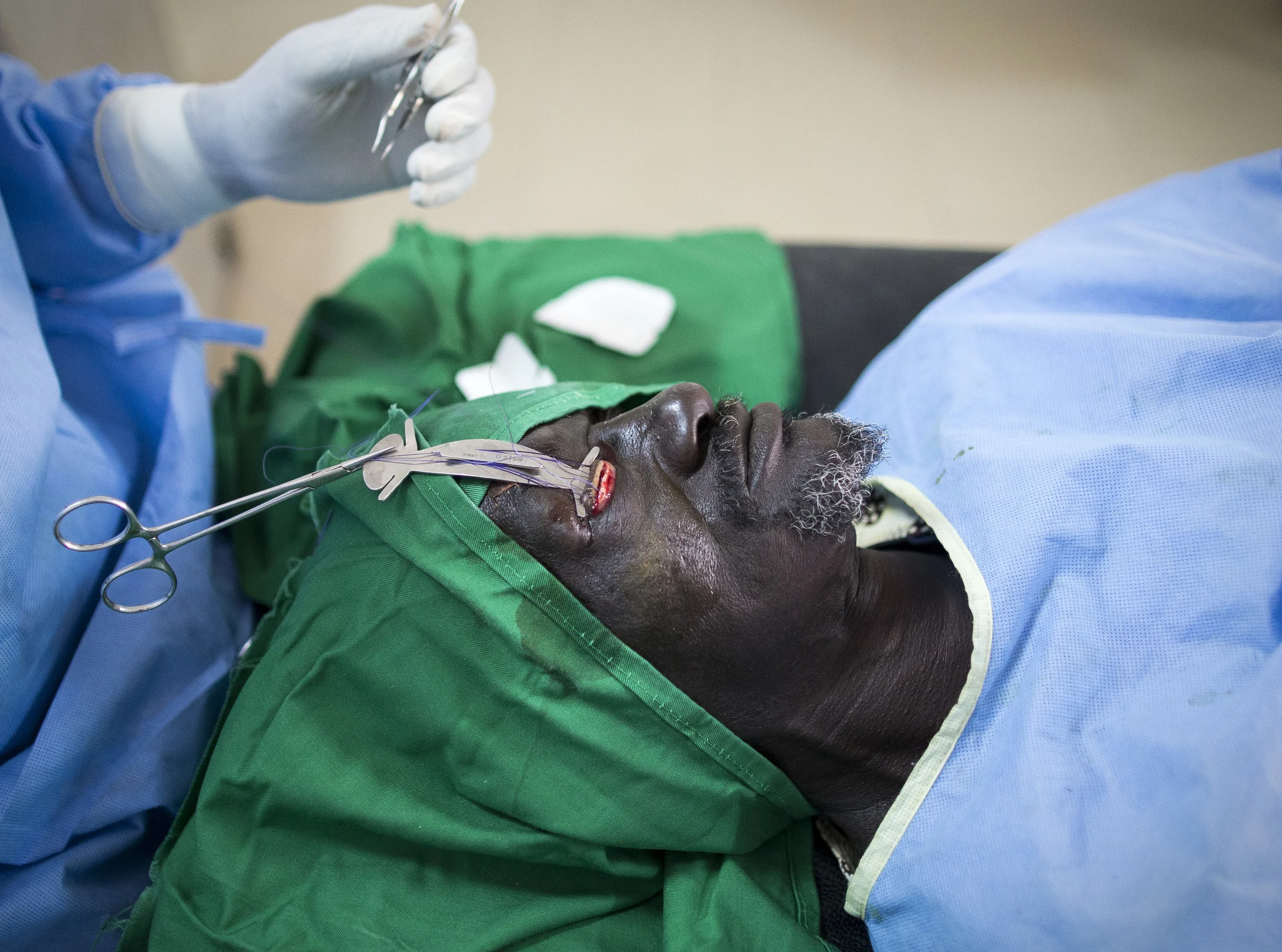  Trichiasis patient Malek Ndao undergoes a double operation at Kaffrin eye clinic, Senegal. Operations made possible by the funding of 'Sightsavers'. &nbsp;November 2013 
