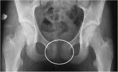 Symphysis Pubis Dysfunction (SPD) a common component of Pregnancy related Pelvic Girdle Pain (PPGP)