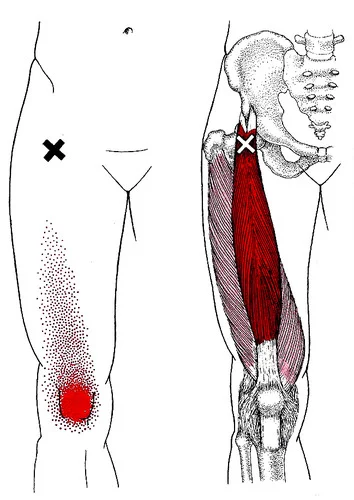 “X” marks the trigger point that refers pain to the front of the knee.