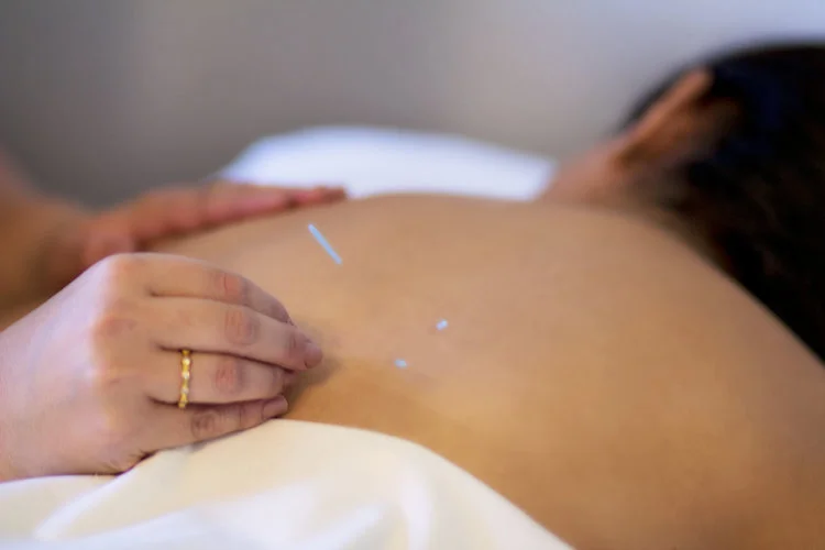 Acupuncture nyc 10001.jpeg