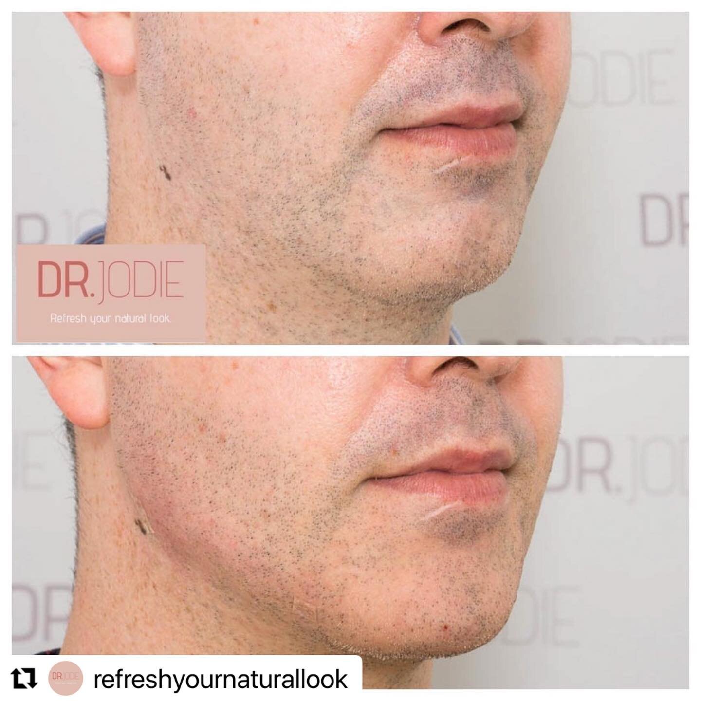 #Repost @refreshyournaturallook with @make_repost
・・・
Remember this lovely guy? Previously I showed you my client&rsquo;s chin post dermal filler treatment. Today we built his jawline even more. And the results speak for themselves! No beard required