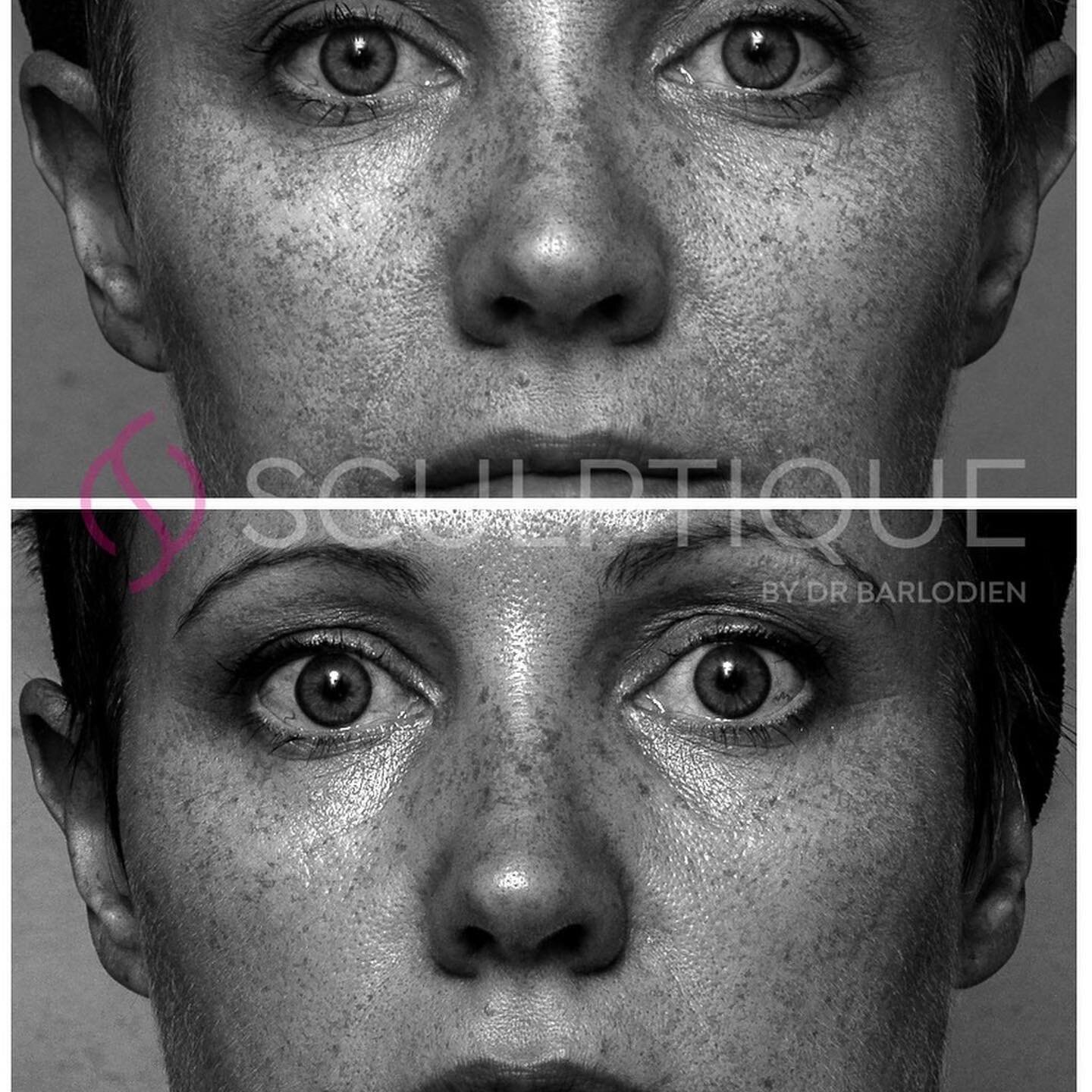 #repost @drbarlodien
・・・
2020 was rough in many aspects but at least I did not let that be the story of my skin.
The first photo was taken in February 2020 when I installed my Clinical Imaging system.
The second was in January 2021.  I used a melanin