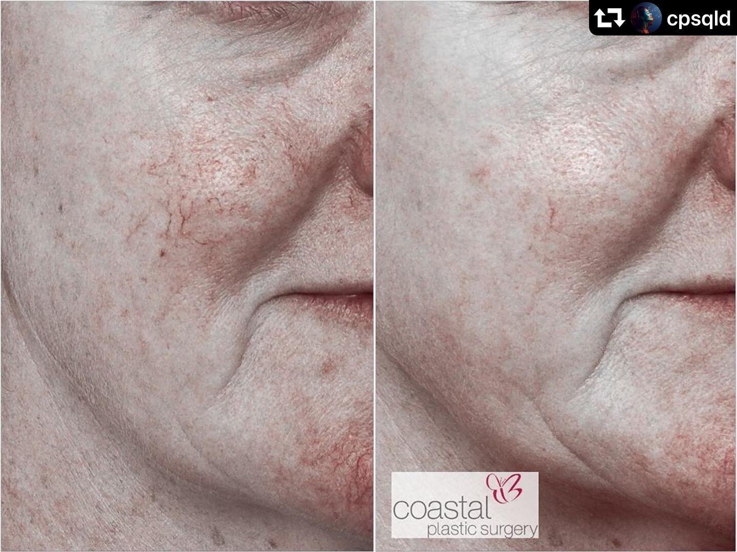 #repost @cpsqld
・・・
Does Vascular Laser work? 💯 %

⚡️This client was concerned about the vascular (redness) and pigment (brown) components of her skin
⚡️ Our Cutera Excel V loves skin conditions which are brown and red 
⚡️This is taken after 2 treat