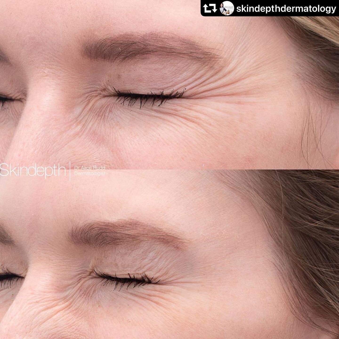 #repost @skindepthdermatology
・・・
These results speak for themselves by @face.by.biriks. One treatment of smile lines (aka crows feet) 2 weeks apart. Notice how this lady smiles with her nose AND eyes... so next treatment ... &lsquo;bunny lines&rsquo