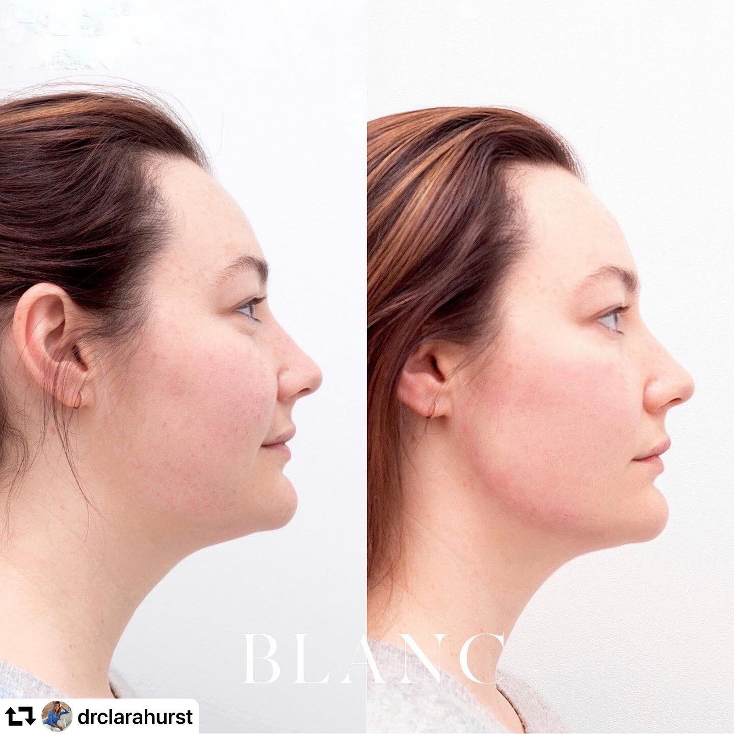 #repost @drclarahurst
・・・
THAT JAWLINE 👌🏼
⠀⠀⠀⠀⠀⠀⠀⠀⠀
At @Blanc_Perth we're thrilled to offer stunning jawline sculpting using premium dermal filler. The treatment offers a slimming, lifting and tightening effect and helps to improve double chin, jow