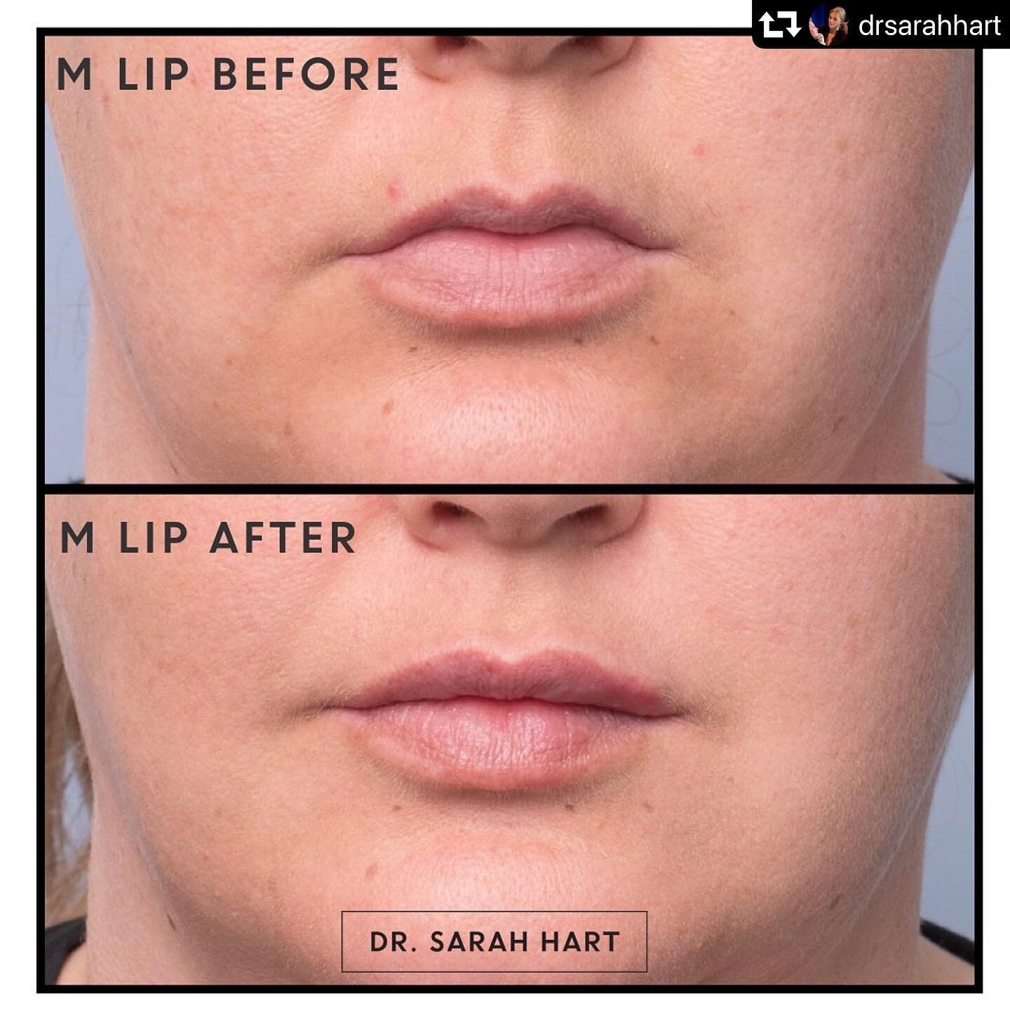 Gold standard @drsarahhart !
&mdash;&mdash;&mdash;&mdash;&mdash;&mdash;&mdash;&mdash;&mdash;&mdash;&mdash;&mdash;&mdash;&mdash;&mdash;&mdash;&mdash;&mdash;- 

#repost @drsarahhart
・・・
I think the M Lip is tricky. Do you agree? 🤪
&mdash;&mdash;&mdash