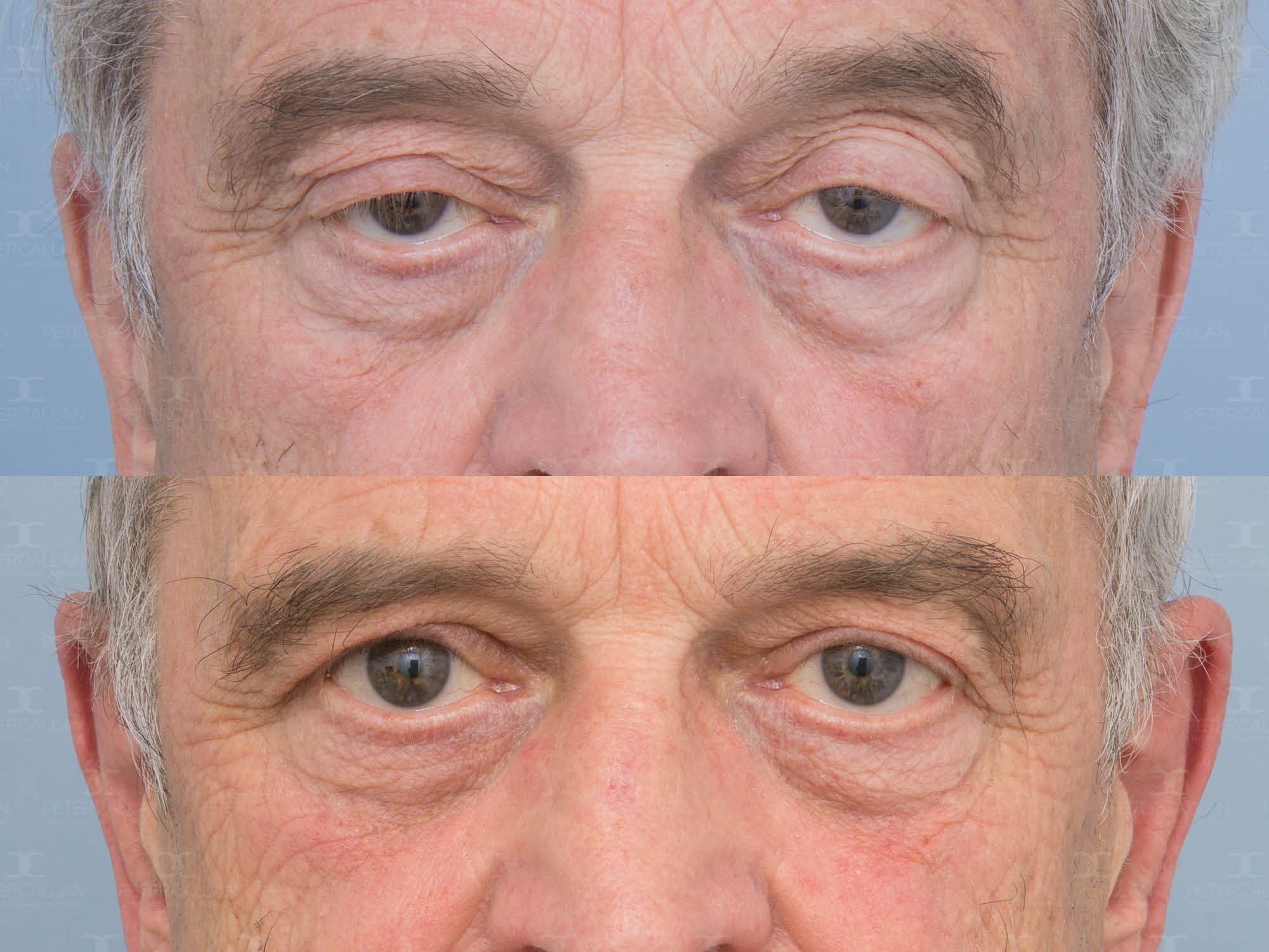 Blepharoplasty-Eyelids-Ptosis-Geelong-Melbourne-Peter-Callan13.jpg