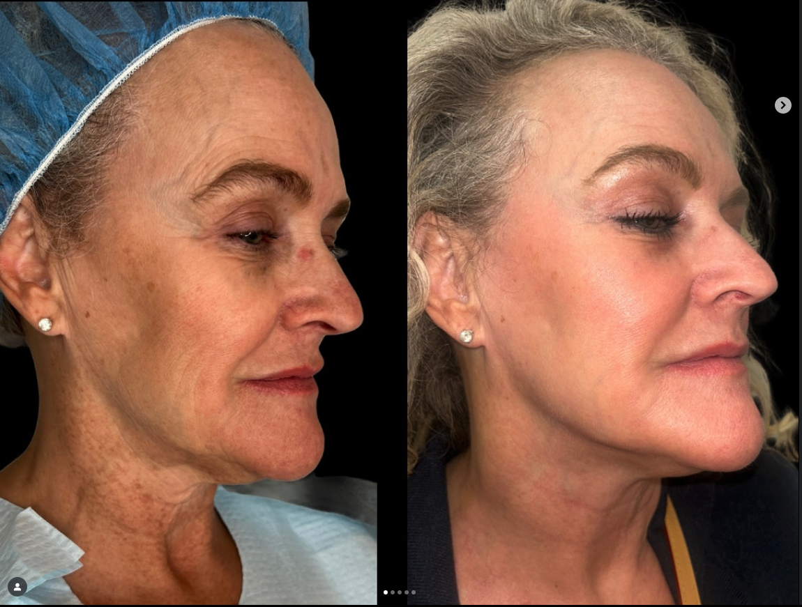 Why your rhinoplasty images aren’t accurate. 