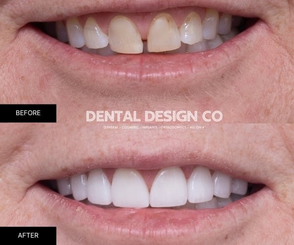 Kelly-Of-Eppings-Crowns-Makeover-In-Dental-Design-Co.jpg