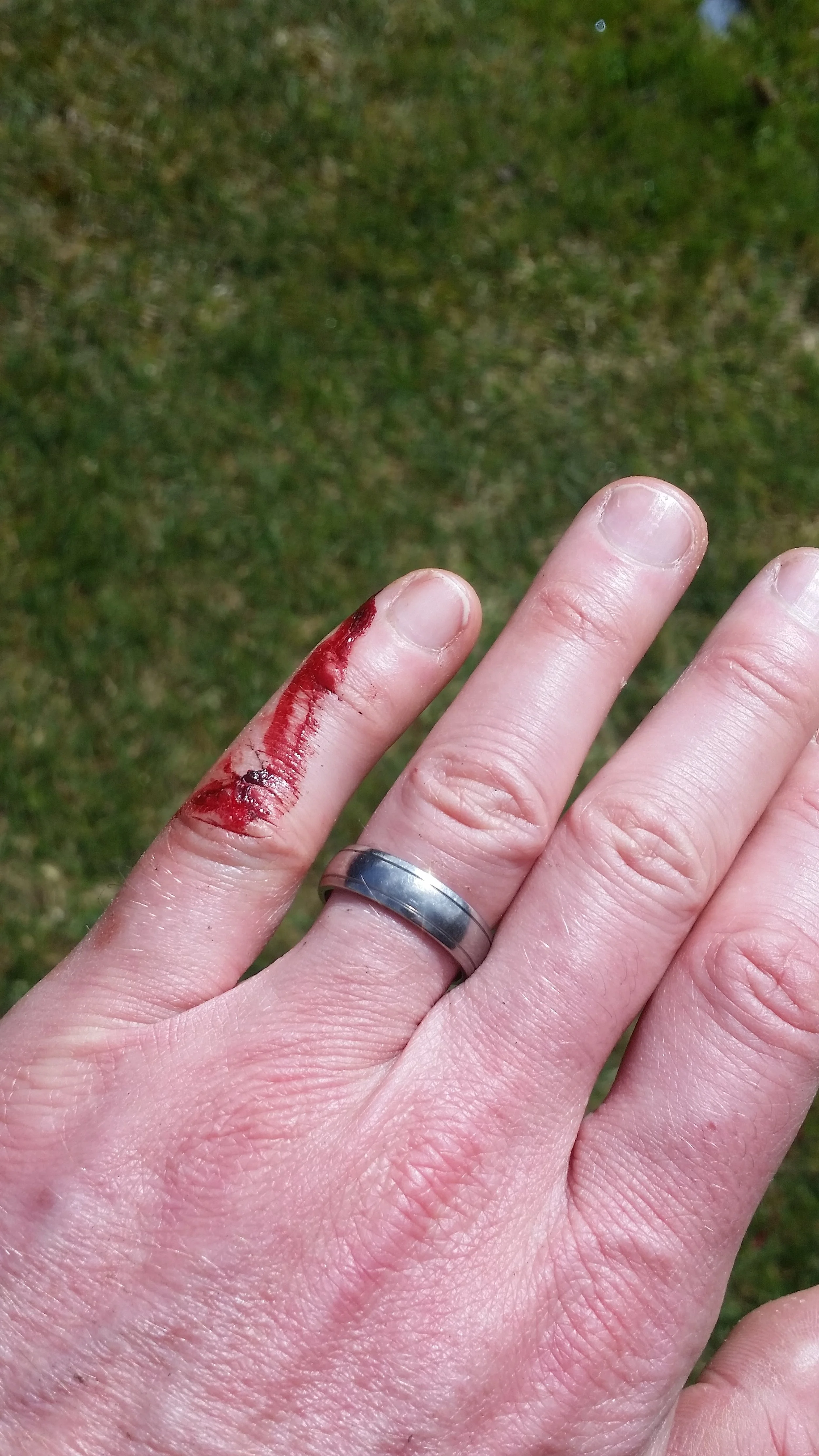 Aftermath of my fall on Mt Buffalo