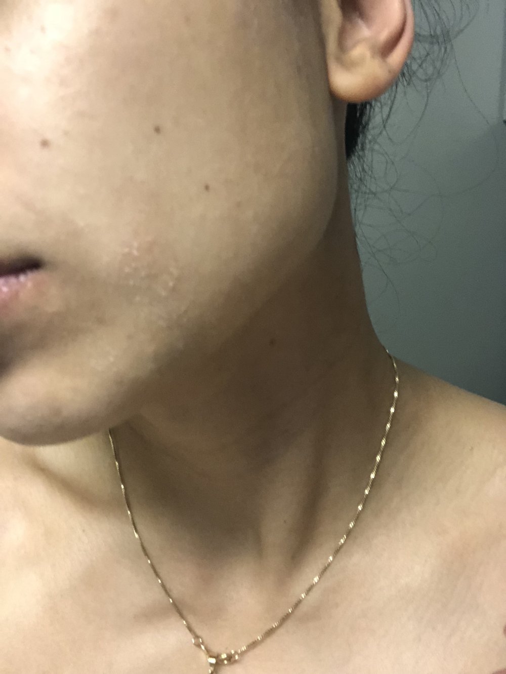 Eczema on the face