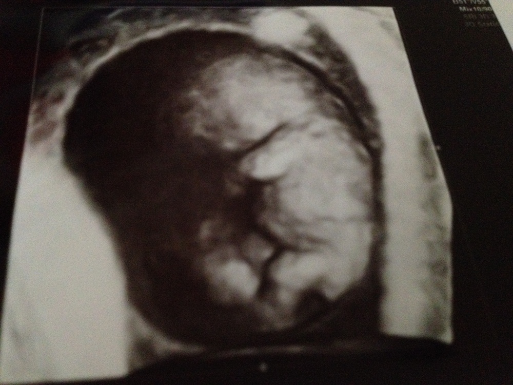 3D sonogram at 9 weeks and 1 day. Amazing. Life is so very precious at every stage.&nbsp;