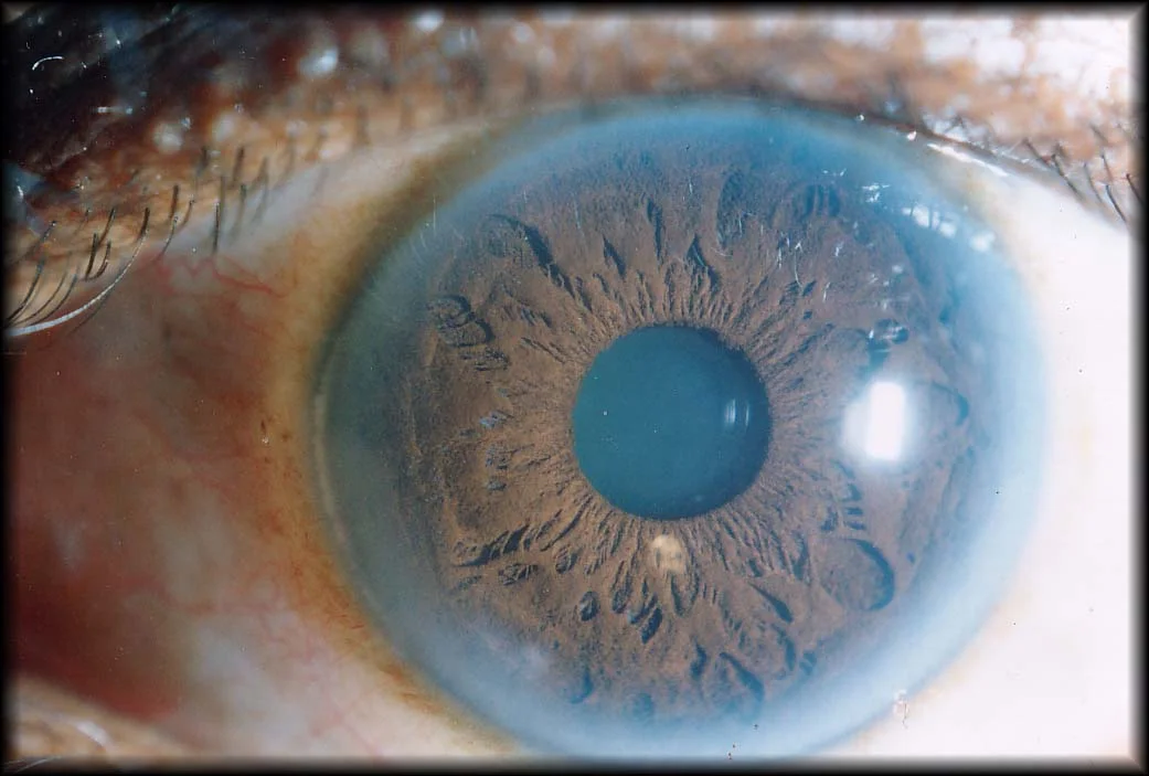 An Iris showing signs of Arterial-plaquing