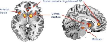 Activation of anterior cingulate, anterior insula, and ventral striatum in a functional MRI scan. 