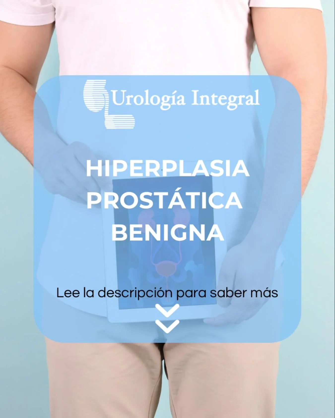 🩺 Hiperplasia Prost&aacute;tica Benigna (HPB): una condici&oacute;n com&uacute;n, pero tratable

La HPB es el crecimiento natural de la pr&oacute;stata que ocurre con la edad.
Aunque es una condici&oacute;n benigna, puede causar molestias urinarias 