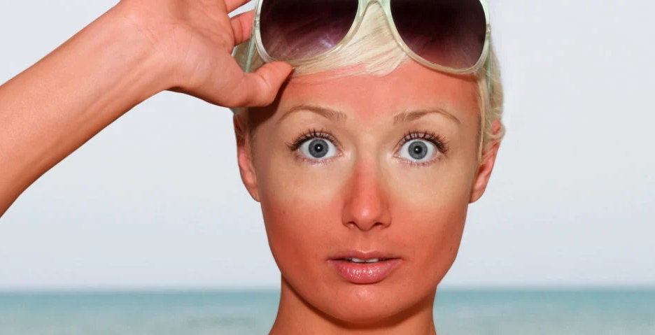 Sunburn Face Mask Recipe