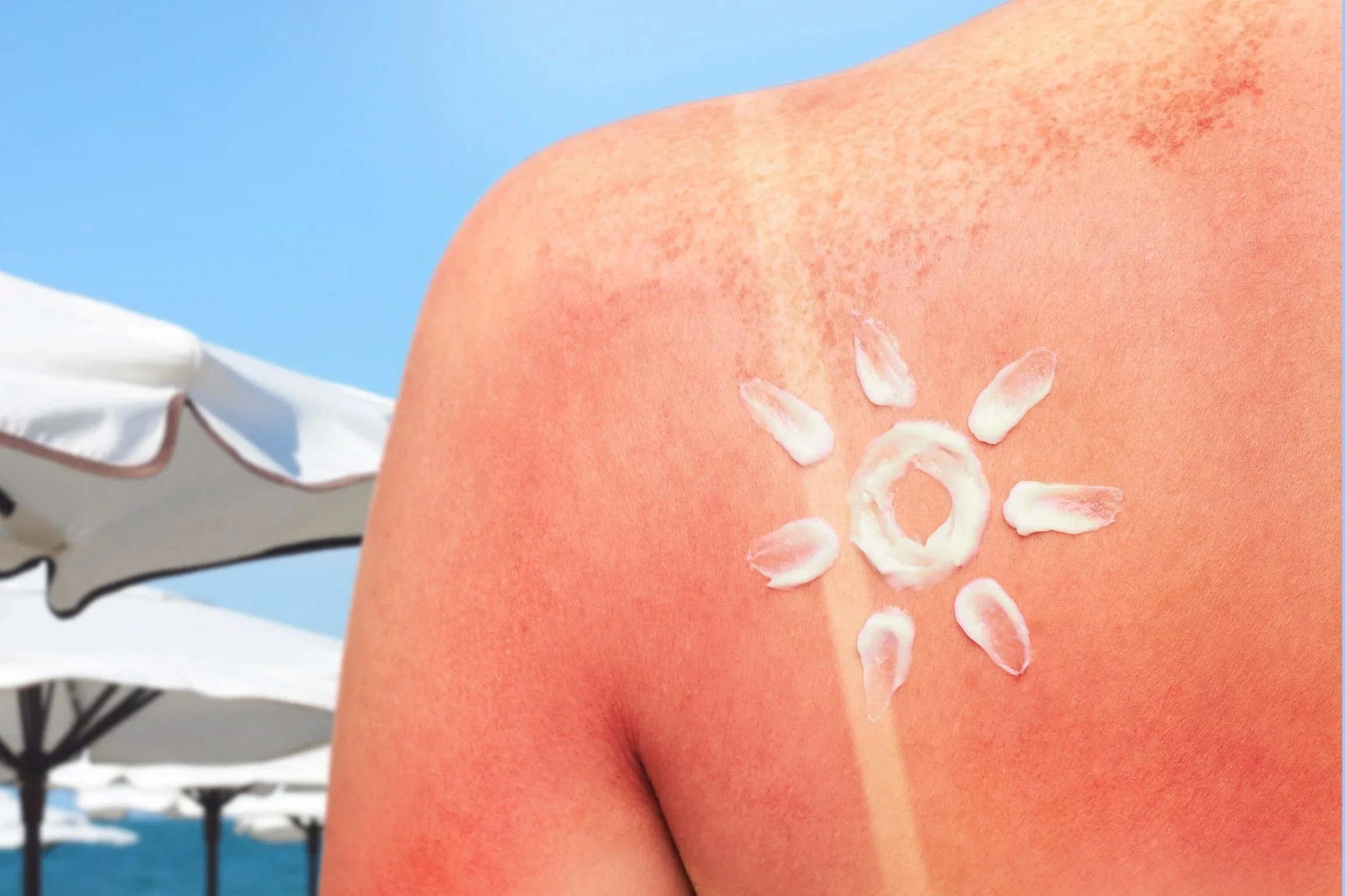 Natural Sunburn Relief 