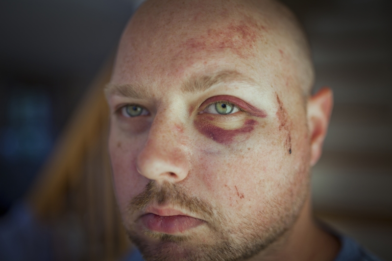 Photo does not convey the pain or how it really looked in person.