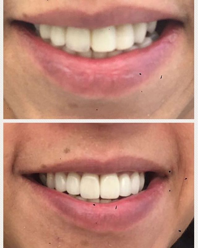 Another opportunity to prefect a beautiful smile #facial enhancement #zirconium crowns #whiteteeth #smiledesign #smile #modelteeth #handmade #porcelainveneers #anythingispossible #diamondfinish #natural #londonteeth @onlyonecliniclondon
