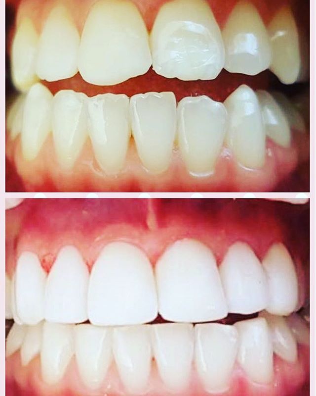 Some Emergency tooth whiting and composite Bonding for a beautiful Bride to be! #bonding #compositebonding #toothmagic#toothwhitening #perfectsmile #androgynous
