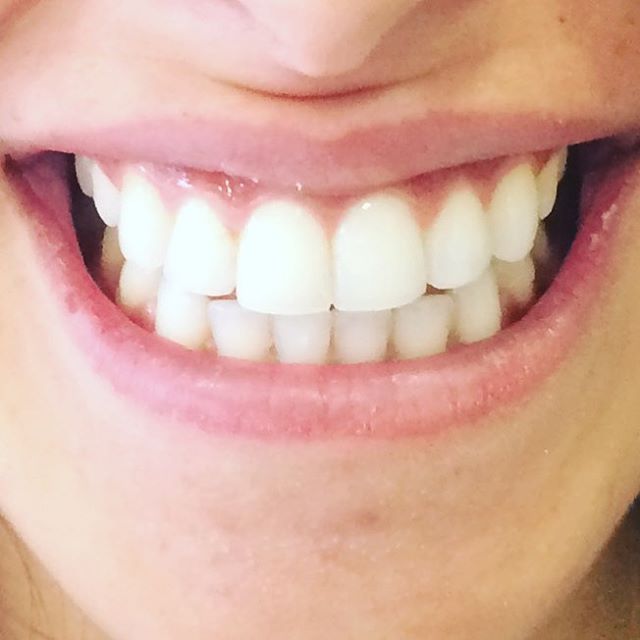 Summer smile ! #bonding #whiteteeth #onlyoneclinic #teethwhitening #teeth #perfection #smile #beautiful