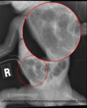 Radiograph of infant with necrotizing enterocolitis.