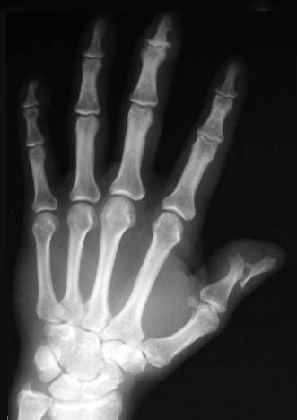 X-ray of patient with psoriatic arthritis