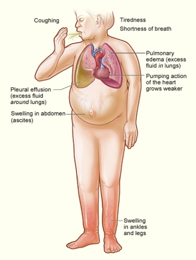 Major signs and symptoms of heart failure.
