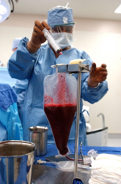 Bone marrow prior to transplant