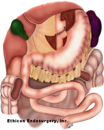 Schematic of Roux-en-Y anastomosis.