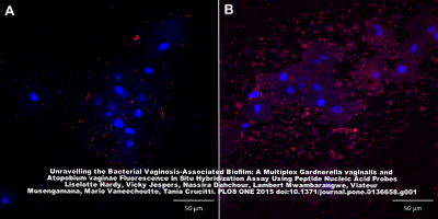 Confocal laser scanning images with 400x magnification of G . vaginalis biofilm in 2 vaginal slides (A and B) in a superimposed image: vaginal epithelial cells in blue and G . vaginalis specific PNA-probe in red. A: vaginal sample with dispersed bacteria; B: vaginal sample with bacteria in biofilm.