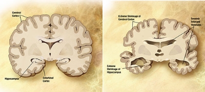 Comparison of a normal aged brain (left) and the brain of a person with Alzheimer's (right). 