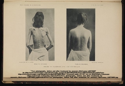 Two photographs, before and after treatment for anorexia