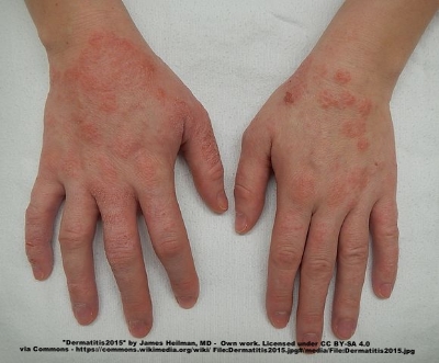 A moderate case of hand dermatitis