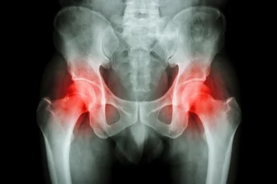 X-Ray Hip.jpg