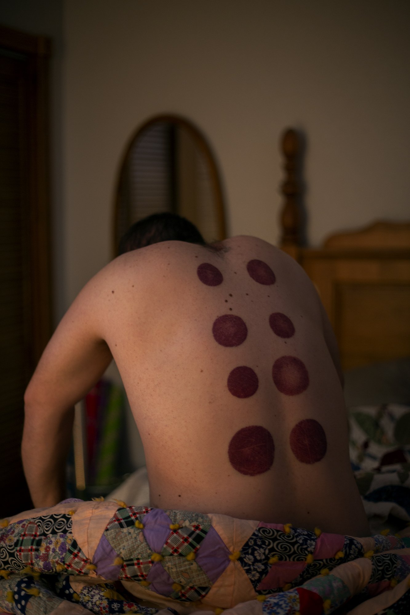 Cupping.jpg