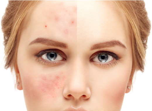 3 Strategies for Acne Treatment