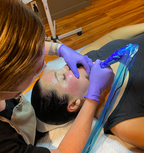 What is Microneedling?