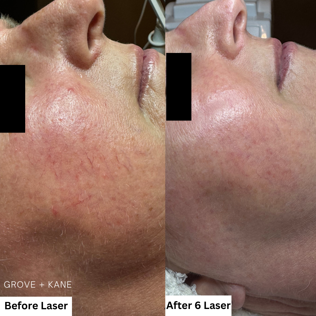 Treating Redness and Rosacea concerns with Laser Treatments.