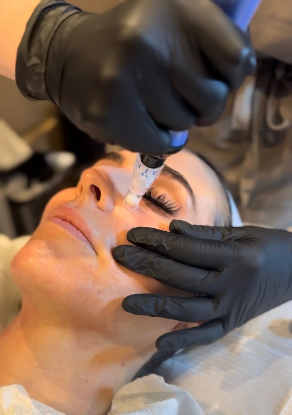 Microneedling at Grove and Kane