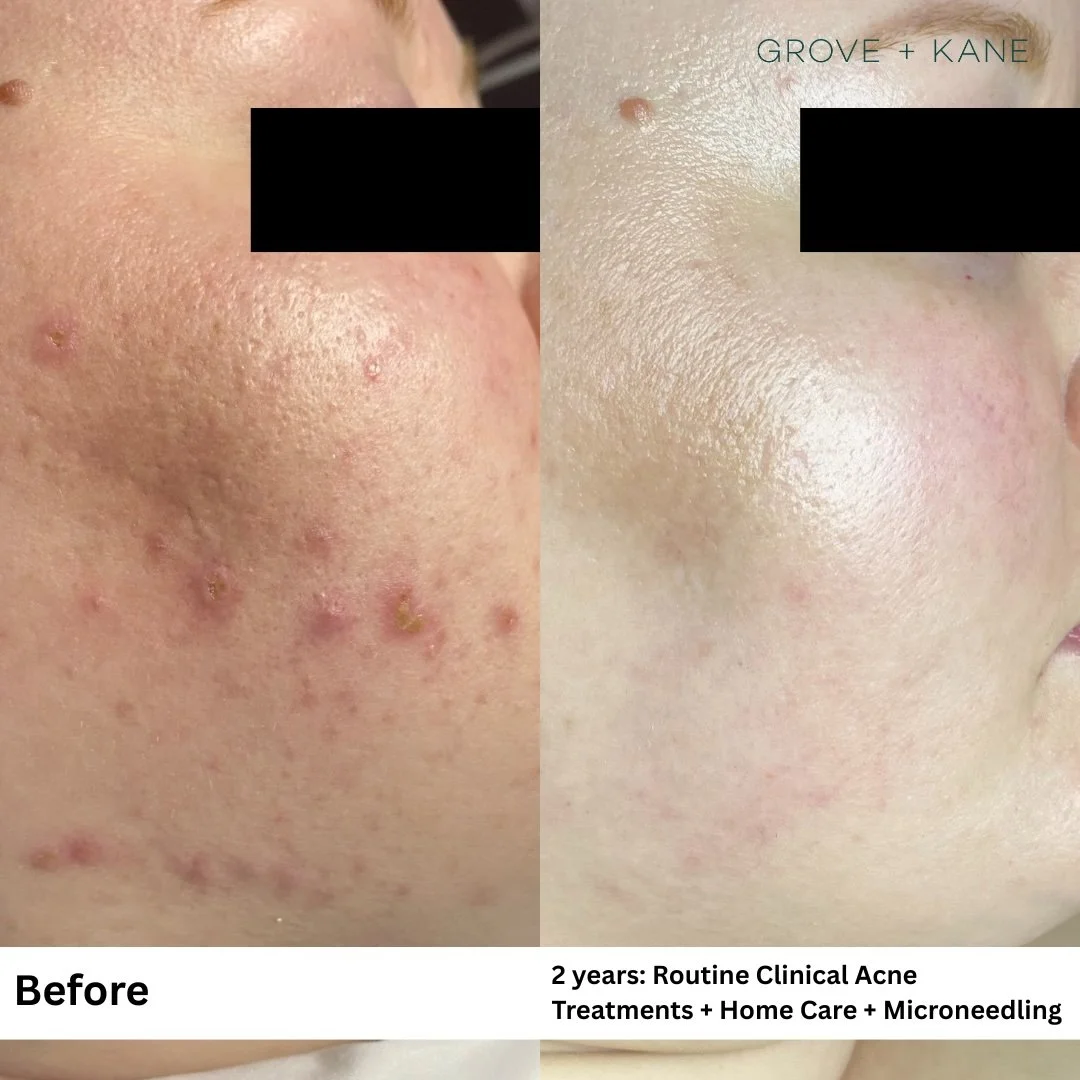 Treating Acne at Grove and Kane
