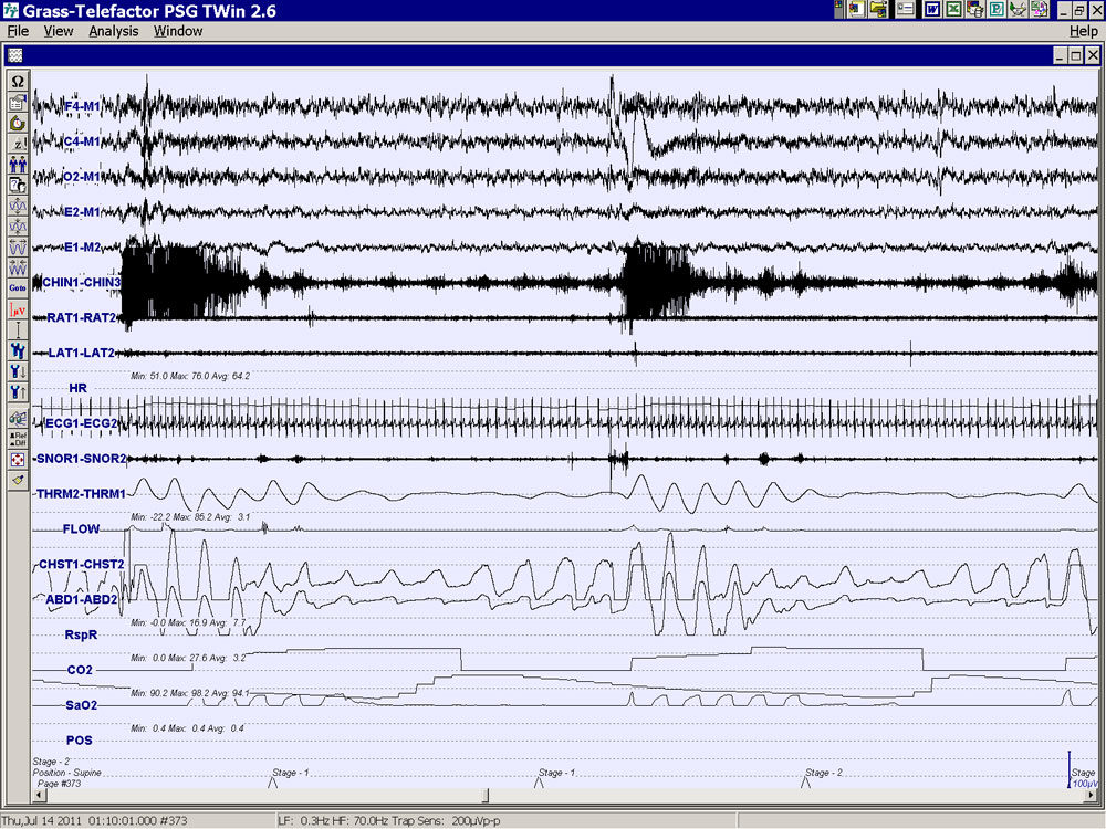 In this example, this patient is experiencing sleep apnea episodes of breathing pauses. The CO2 monitor shows increasing carbon dioxide as the SaO2 monitor shows plummeting oxygen desaturations and hypoxia. In the Chin and EEG brain wave activity we see the patient's brain is briefly waking the patient up with corresponding arousals in response to the sleep apnea. And yet, after each arousal and airway opening, the patient falls right back asleep, the sleep apnea resumes again, and another corresponding arousal occurs. This sleep apnea severity is likely responsible for significant sleep architecture disruption, paucity (or reduced) restorative sleep, daytime fatigue and sleepiness, reduced concentration at work or when driving, and many other significant health risks. The repeated loss of oxygen and increased carbon dioxide also stress the heart and increase hypertension, diabetes, heart attack, and stroke risk factors.