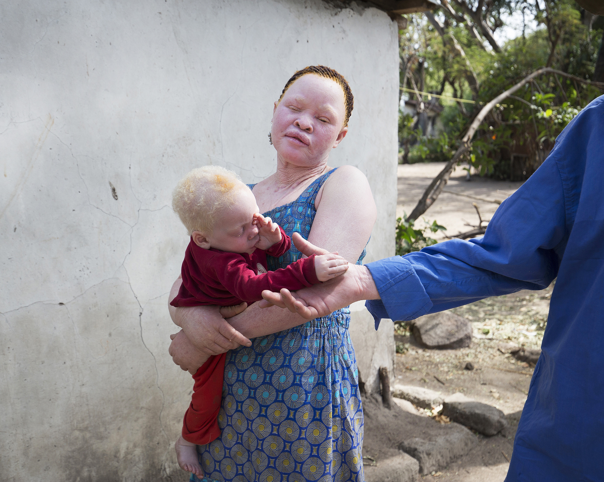 In many communities dangerous myths that 'children with albinism were produced because the ghost of colonialists impregnated their mothers' lead to husbands abandoning their wives and family's. Babies are routinely slaughtered at birth; those who survive often endure years of abuse.