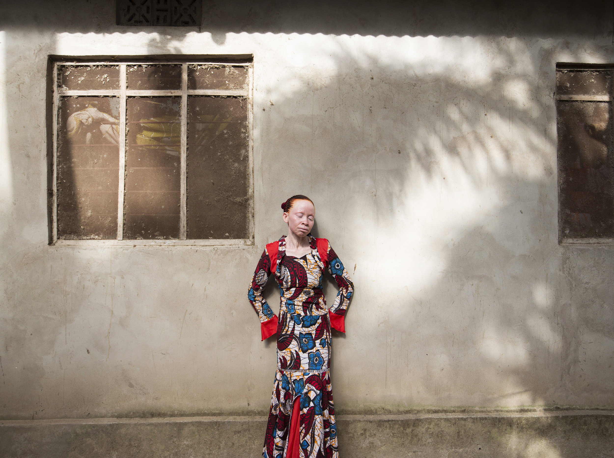 The bodies of people with albinism are frequently said to possess magical properties, able to cure disease or deliver fortune. Sex with a woman with albinism is thought to cure AIDS which in some communities leads to rape.