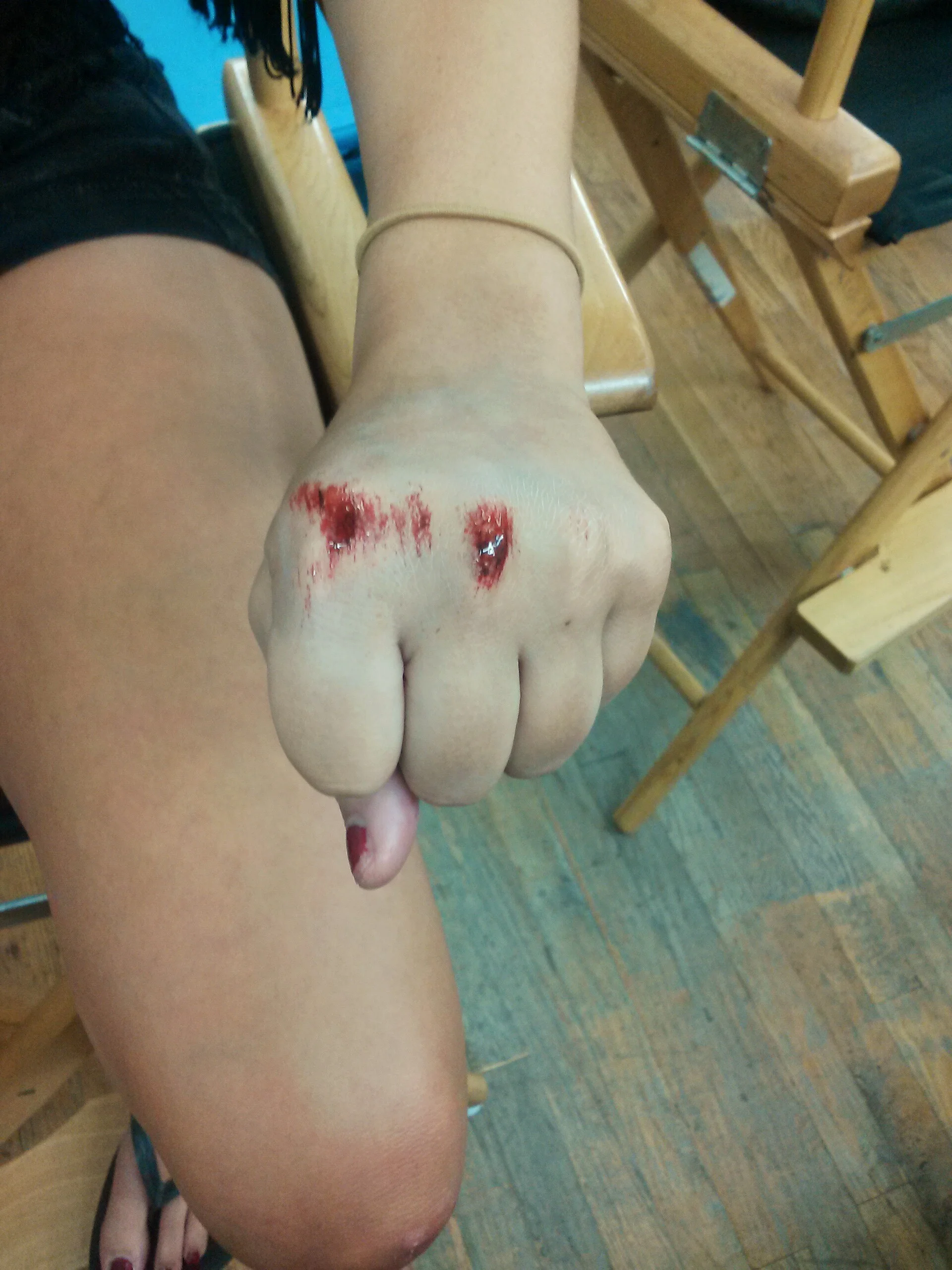 scraped knuckles