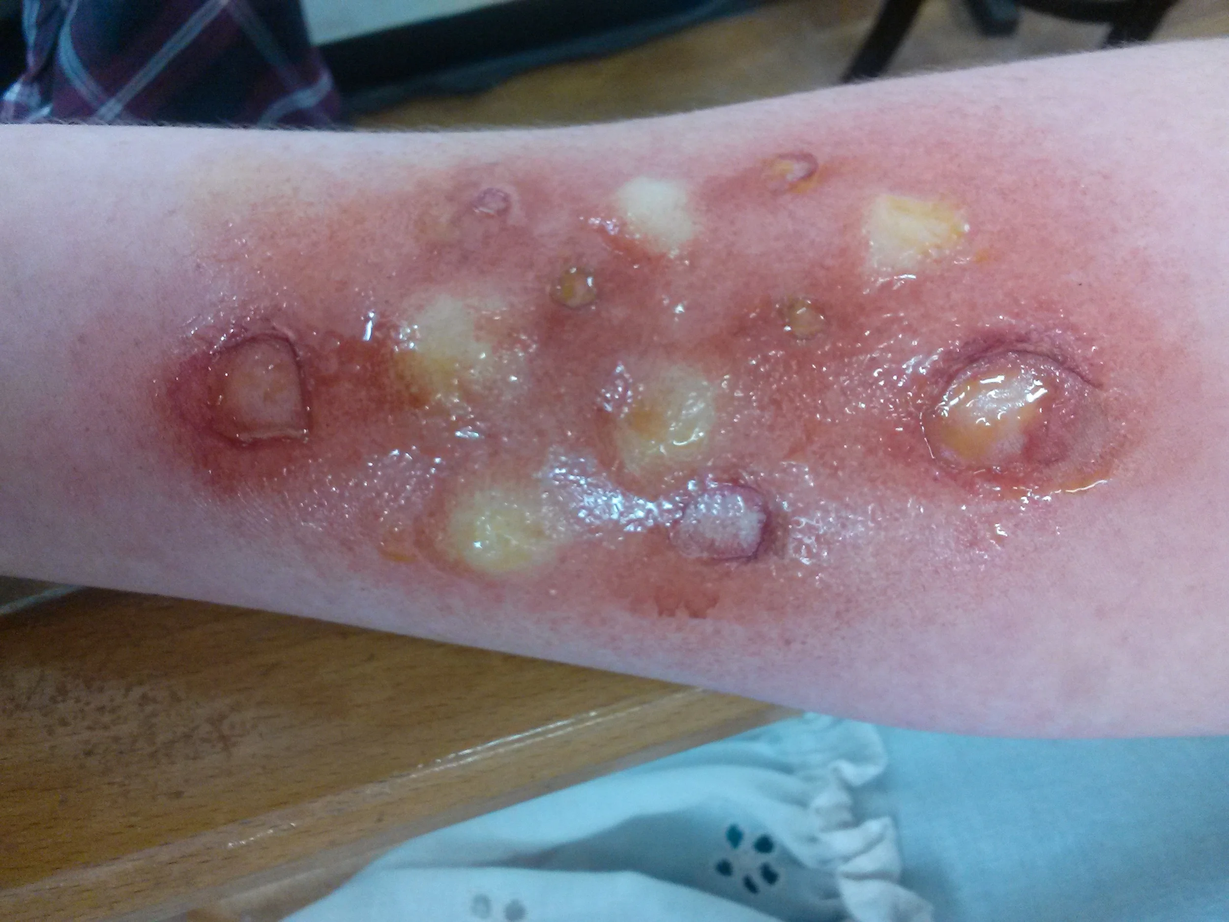 2nd degree burn