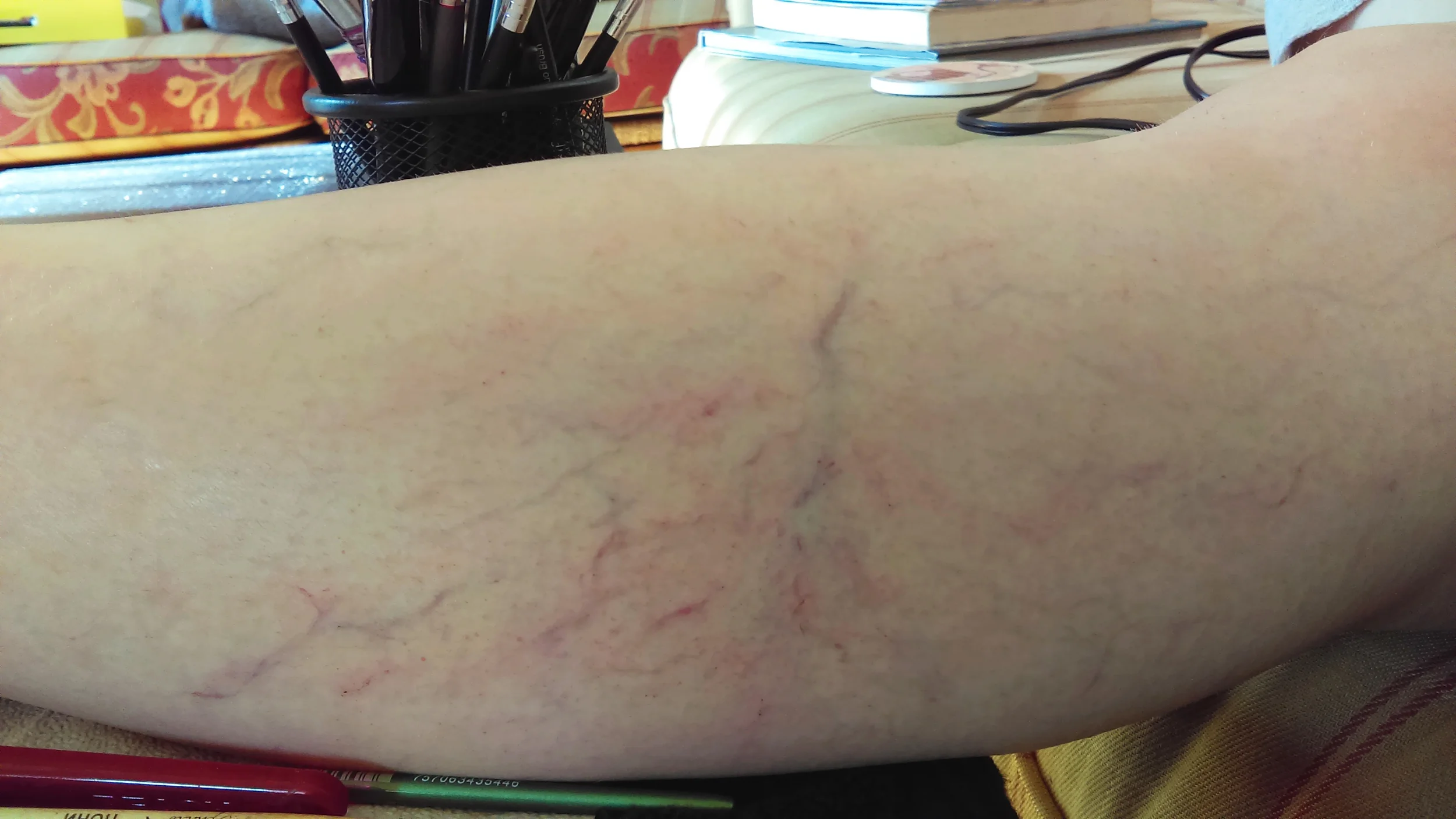 varicose veins