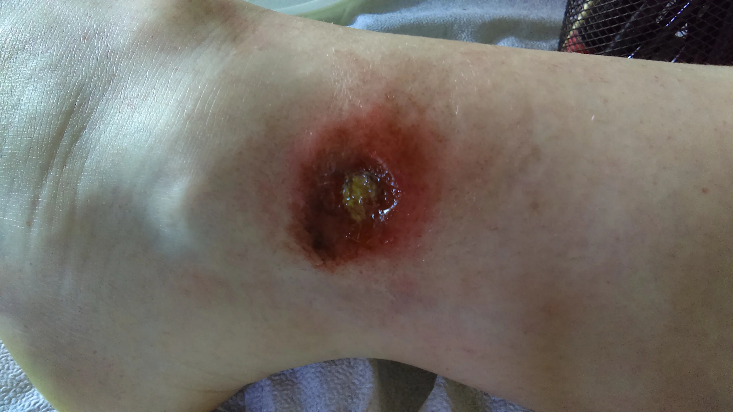 spider bite infection
